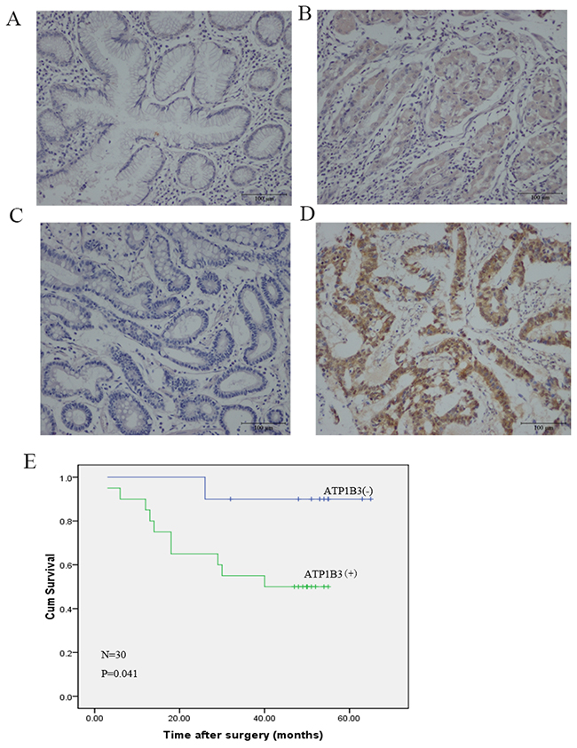 ATP1B3 expression is increased in human gastric cancer tissues.