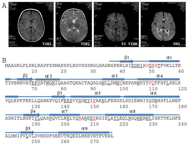 Brain MRI and DGUOK structure.