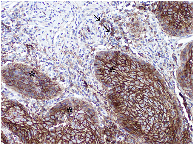 Microphotograph of immunohistochemical staining for PD-L1 within primary vSCC: (stars) expression on cancer cells, (arrows) expression on immune cells.