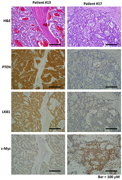 The hematoxylin and eosin (H&#x0026;E) and immunohistochemical staining patterns for LKB1, PTEN, and c-Myc in the PNET tumor cells are shown (200&#x00D7;).