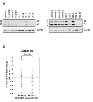 Reduction of CDK9-55 protein expression after flavopiridol therapy is correlated with the response in OSU-0491 clinical trial.
