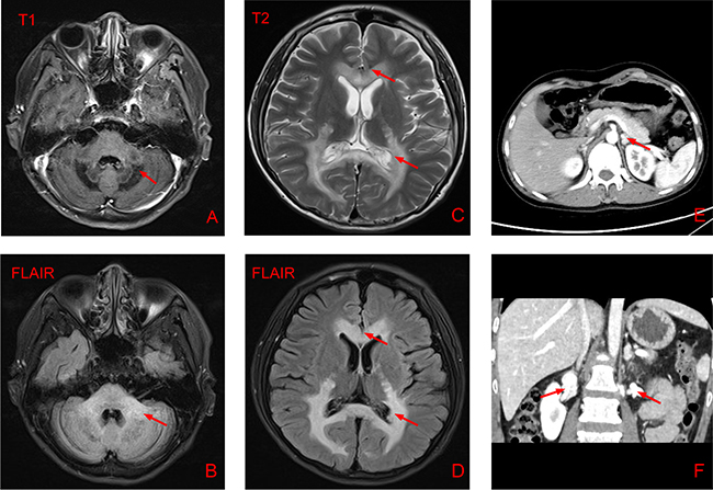 Results of brain magnetic resonance imaging and abdominal computed tomography.