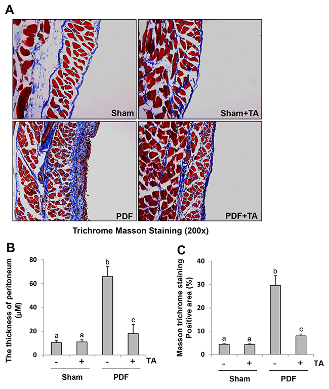 Administration of TA inhibits development of peritoneal fibrosis in a murine model of peritoneal fibrosis induced by high glucose dialysate.