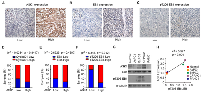 EB1 phosphorylation correlates with ASK1 expression in pancreatic cancer.