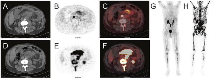 Image example of a clinically indicated [68Ga]Pentixafor PET/CT scan of a 74 year old patient with castration-resistant metastasized prostate cancer after all approved systemic therapies.