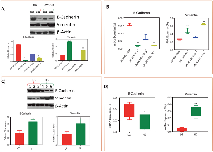 Correlation of GD2 +/- EMT phenotype with low grade and high grade tissues of BLCA patients.