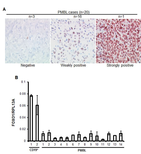 FOXO1 is downregulated in PMBL.