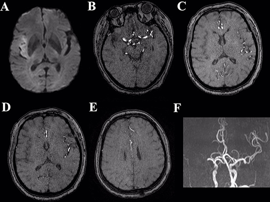 Illustrative case depicting the collateral status from preoperative MRI.