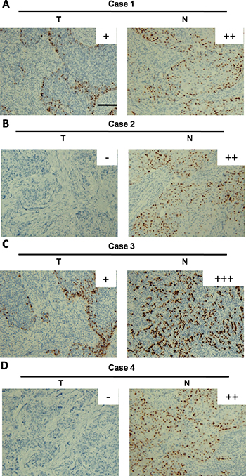 Immunohistochemical analysis of GPD1 protein expression in breast cancer tissues.