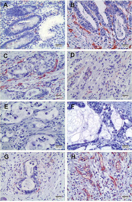 The expression of SPARC protein in human non-cancerous and gastric cancer tissues demonstrated by immunohistochemical staining.