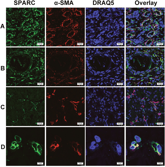 The expression of SPARC protein by cancer-associated fibroblasts in human gastric cancer tissues.