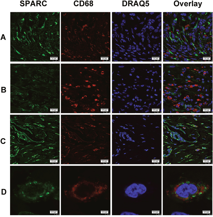 The expression of SPARC protein by tumor-associated macrophages in human gastric cancer tissues.