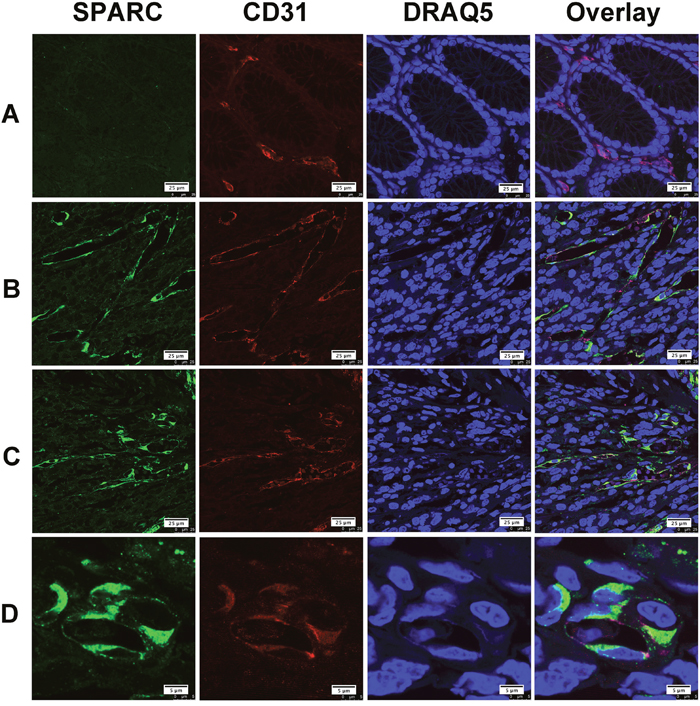 The expression of SPARC protein by vascular endothelial cells in human gastric cancer tissues.