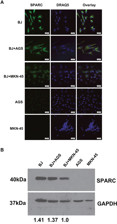 The expression of SPARC protein in a co-culture model of human fibroblasts and gastric cancer cells.