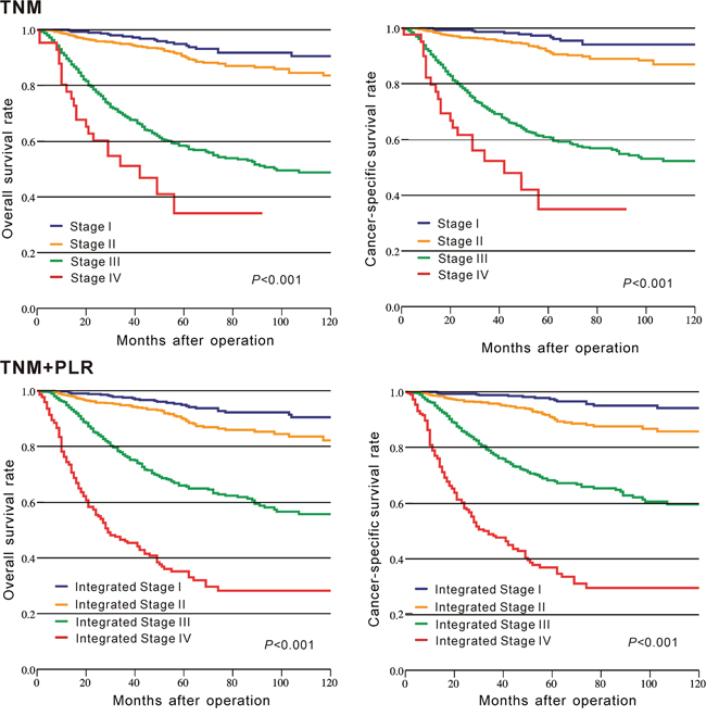 Kaplan&#x2013;Meier curves of survival based on TNM staging and TNM staging combined with the platelet to lymphocyte ratio in CRC patients from CMU-SO.