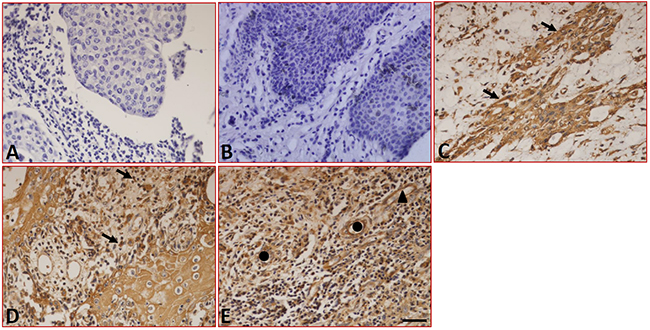 Expression of B7-DC in LC tissues detected by immunohistochemistry.