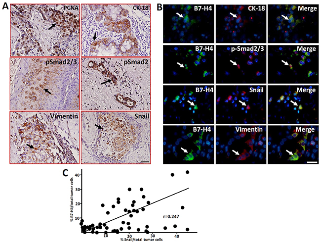 Expression of the cell proliferation marker PCNA and EMT-related markers in human LC samples detected by immunohistochemistry.