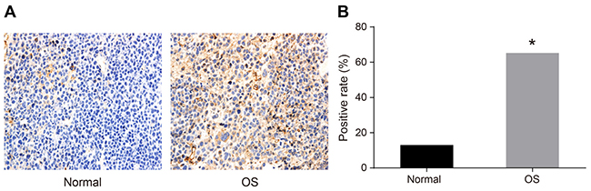 Immunohistochemical analysis of HOXA9 expression in OS compared to normal tissue.