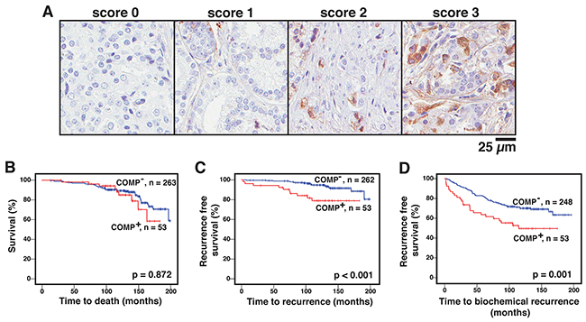 COMP expression in prostate cancer cells is correlated with shorter time to recurrence.