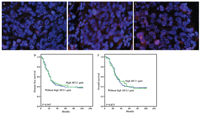 Representative fluorescence in situ hybridization (FISH) signal patterns of select MCL1 anomalies and the prognostic significance of high MCL1 gain in full cohort.