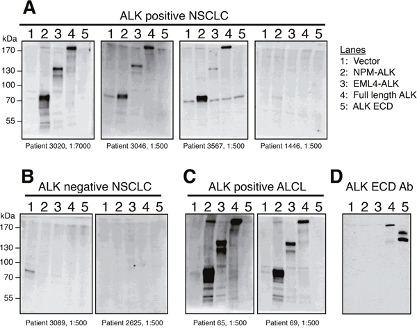 Western blot analysis confirms that ALK-positive NSCLC patient serum specifically recognizes the ALK intracellular domain (ICD).