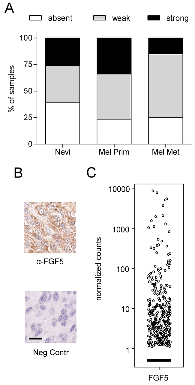 FGF5 is expressed in human melanoma tissue.