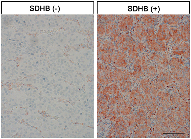 SDHB expression in paragangliomas.