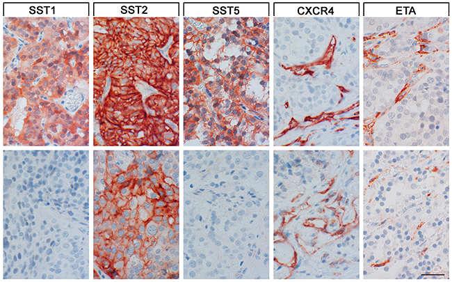 SST, CXCR4 and ETA expression in paragangliomas.