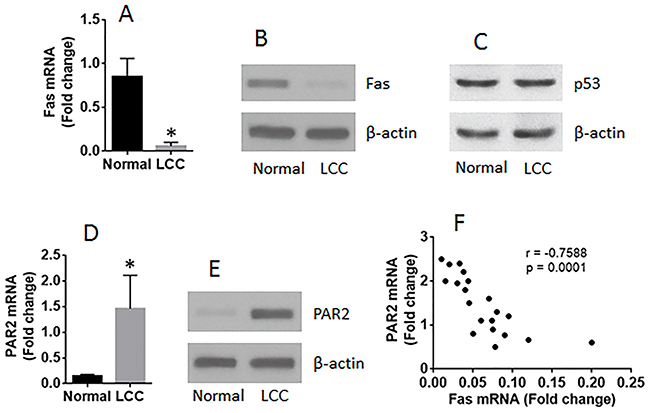 The expression of Fas is negatively correlated with PAR2 expression in LCCs.