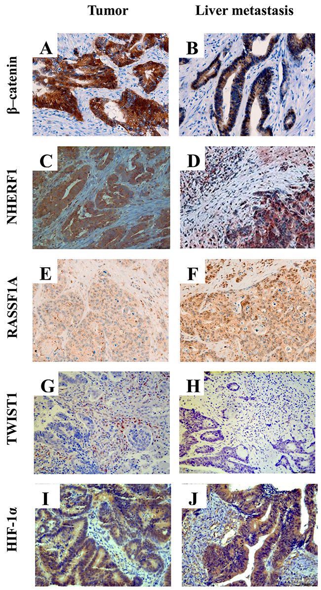 Representative images of immunohistochemical staining of &#x03B2;-catenin, NHERF1, RASSF1A, TWIST1 and HIF-1&#x03B1; proteins.