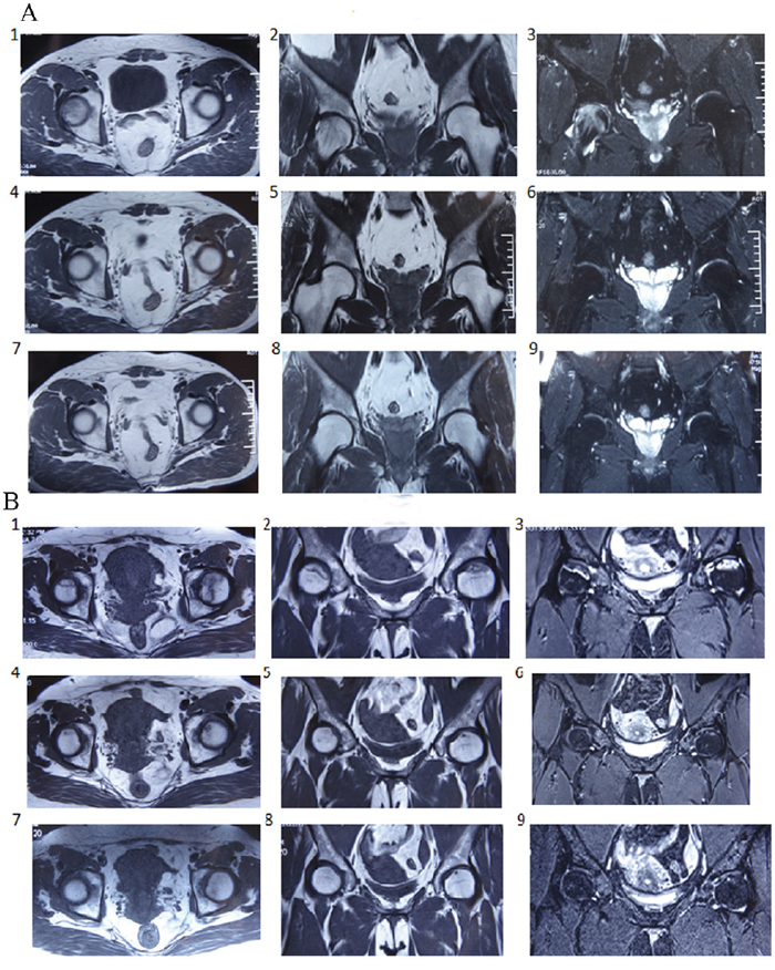 Representative case of osteonecrosis of the femoral head (ONFH) evaluated by magnetic resonance imaging (MRI).