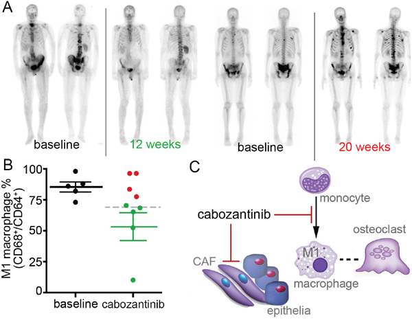 Monocyte-derived M1 macrophages can serve as a biomarker for cabozantinib efficacy in PCa bone metastasis.