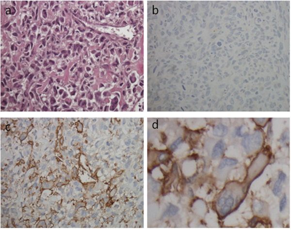 Representative pictures of immunohistochemical staining of osteosarcoma TMA punches with CD49b antibody.