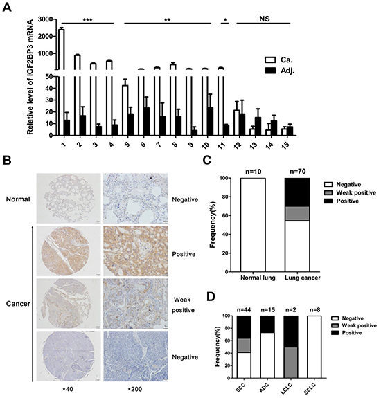 Increased expression of IGF2BP3 in lung cancer tissues.