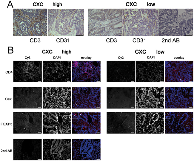 CXCL11 expression is correlated with T-cell infiltration.