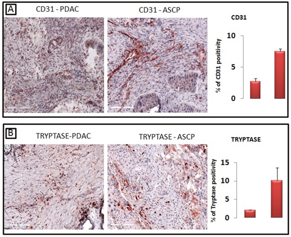 A greater number of CD31-positive microvessels are present in ASCP compared with PDAC, as confirmed by morphometric evaluation (A).