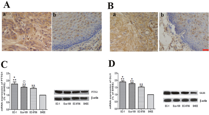 The expression of PTTG1 and GLI1 in ESCC tissues and cell lines.