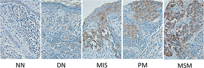 Tissue micrographs of immunohistochemistry staining of melanoma biopsies.