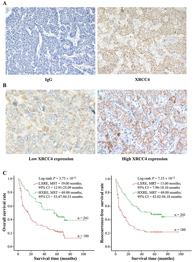 The association between XRCC4 expression and hepatocarcinoma prognosis in the 421 cases.