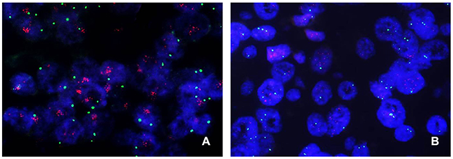 Representative images of c-MYC FISH in breast cancer.
