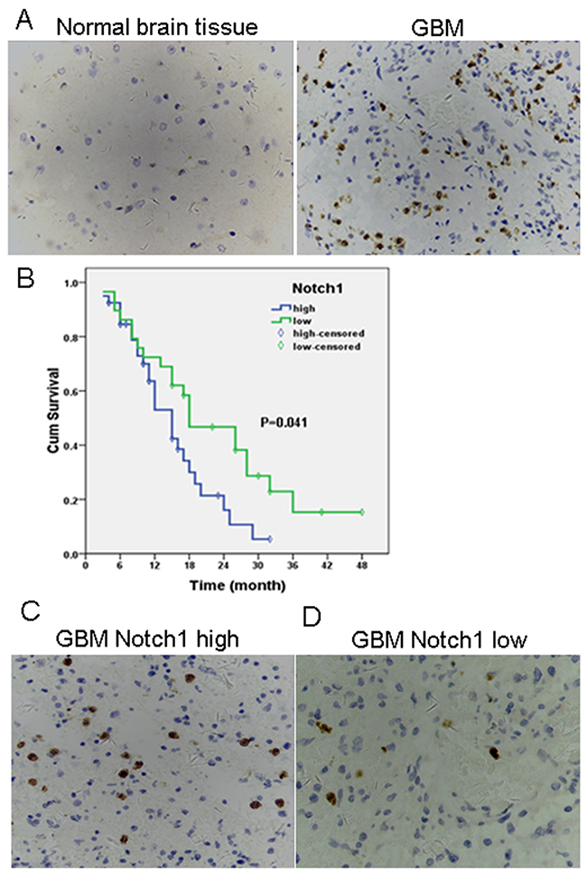 High levels of Notch 1 expression are present in GBM and high tumor Notch 1 expression correlates with worse prognosis.