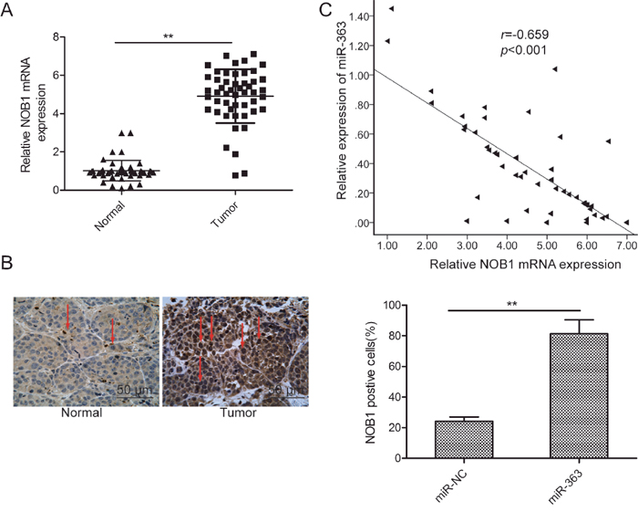 NOB1 expression inversely correlates with miR-363 levels in patient OC tissues.
