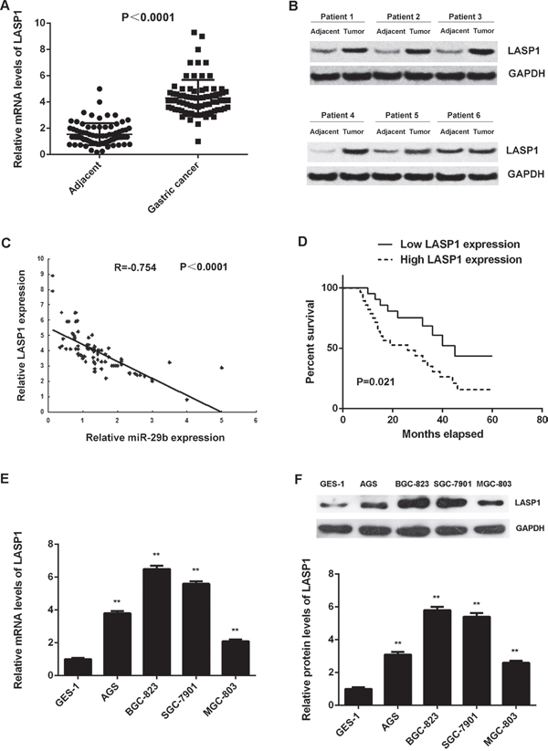 LASP1 is significantly upregulated in gastric cancer.