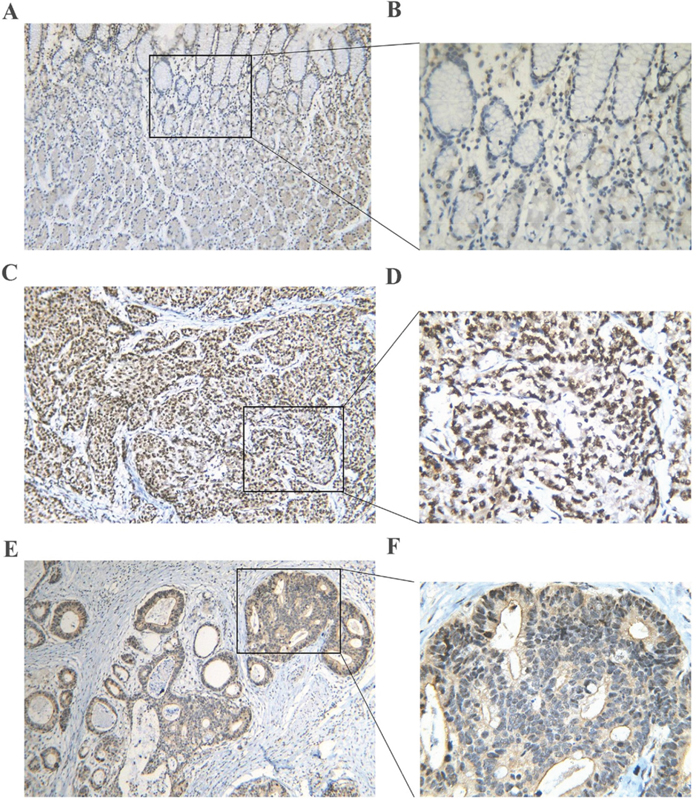 PLK1 protein expression in gastric cancer and non-tumor tissues assessed by immunohistochemistry.