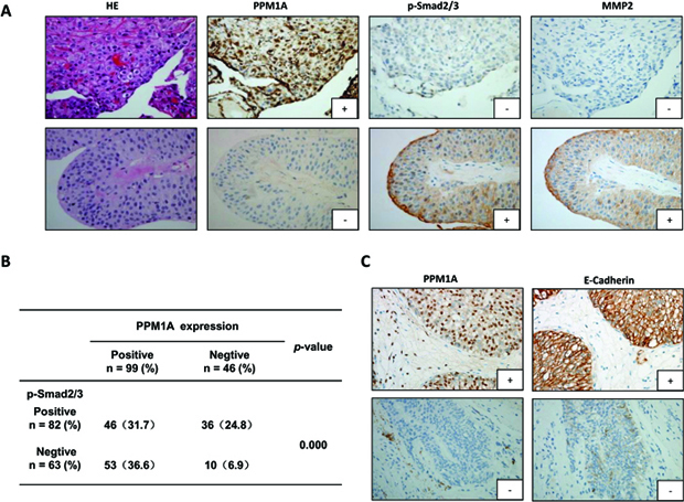 Immunohistochemical staining for PPM1A, p-Smad2/3, MMP2 and E-cadherin in 145 BCa samples