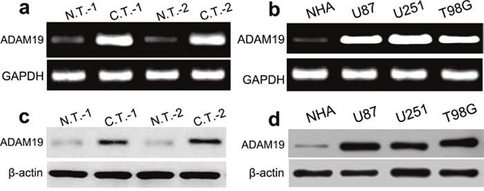 ADAM19 is increased in GBM tissues and cell lines.