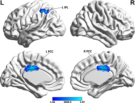 Brain map of the voxel-wise meta-regression analysis of MMSE scores in the AD samples.