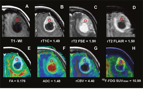 Conventional, advanced MRI and 18F-FDG PET/CT/MR fusion image of a frontal GB.