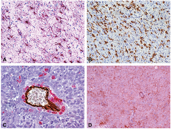 Reactive astrocytes, microglia/macrophages and edema in a peritumor stereotactic biopsy specimen.