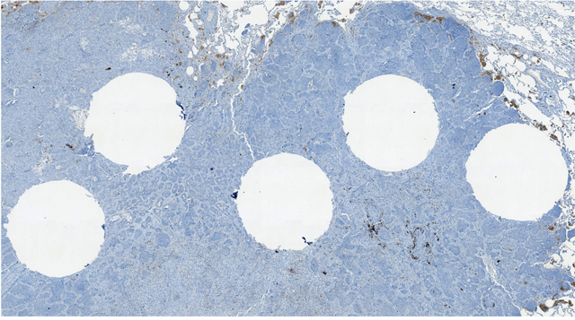 Representative whole section of a case negative for PD-L1 expression; white holes correspond to TMA cores.